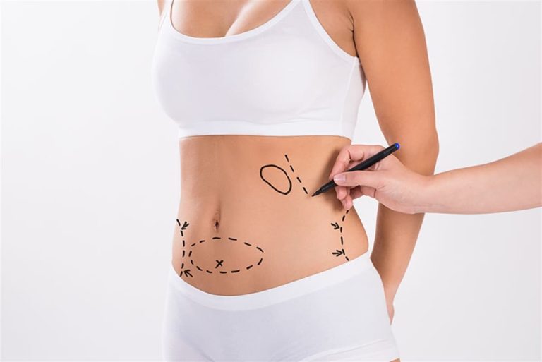 Liposuction Ameliyatı Nasıl Yapılır?