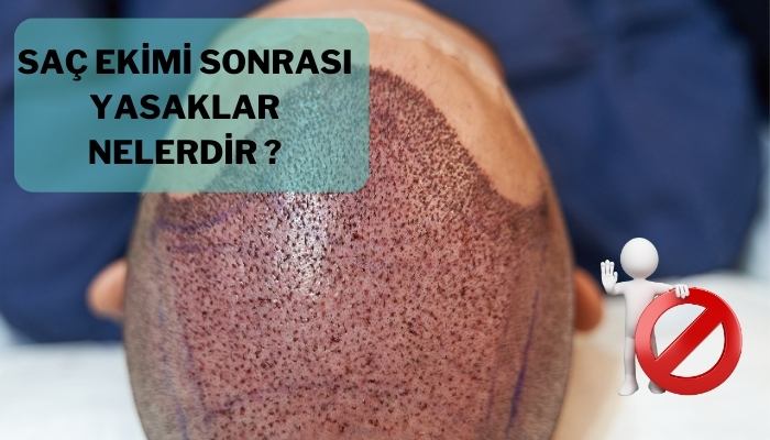 Saç Ekimi Sonrası Yasaklar Nelerdir?