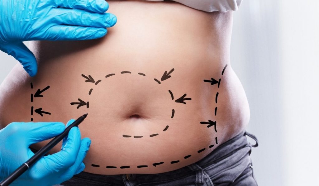 liposuction ameliyatı