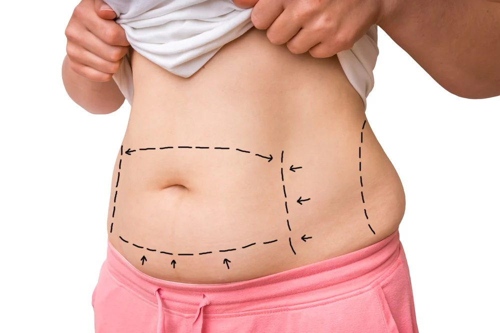 liposuction nedir